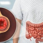 女性小腸氣常見誤區解析！甚麼時候需要就醫？