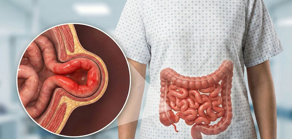 女性小腸氣常見誤區解析！甚麼時候需要就醫？